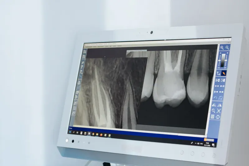 An X-ray of teeth and roots on a white screen in a modern dental room